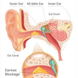 Earwax blockage illustration