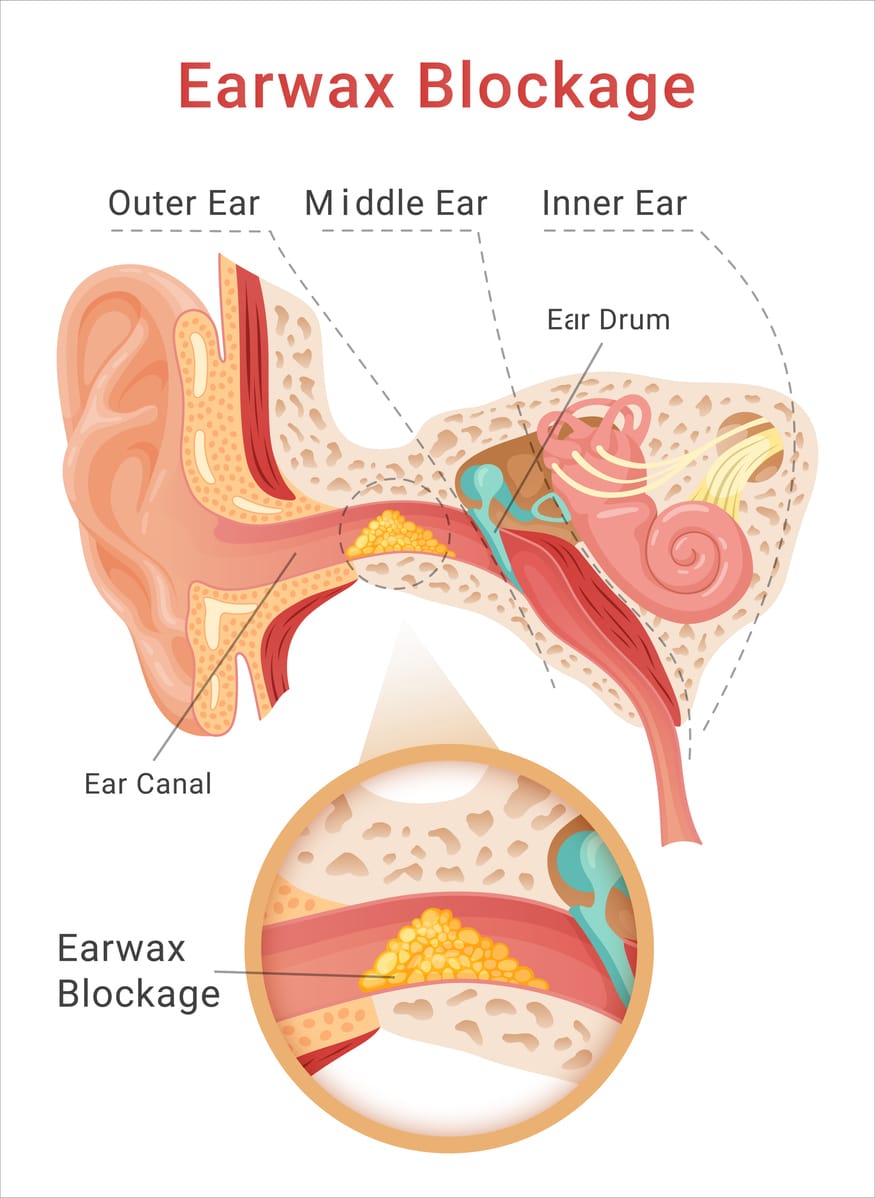 Earwax blockage illustration.